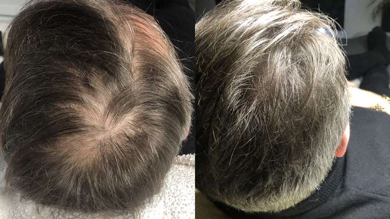 Kopfhaut Pigmentierung