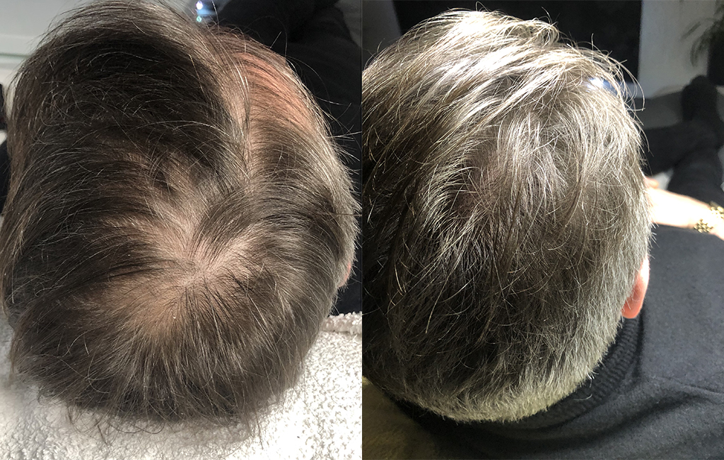 Kopfhaut Pigmentierung